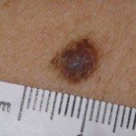 Is a Mole Normal if It’s Brown and Grey or Can It Be Melanoma?