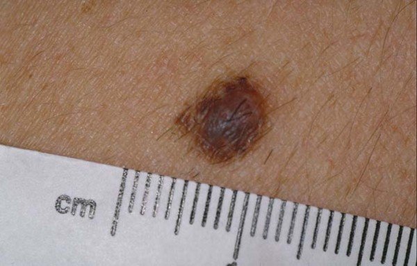 Is a Mole Normal if It’s Brown and Grey or Can It Be Melanoma? » Scary ...