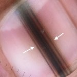 Longitudinal Melanonychia vs. Subungual Melanoma