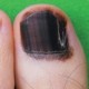 Toenail (Subungual Hematoma) vs. Melanoma: Visible Differences » Scary ...