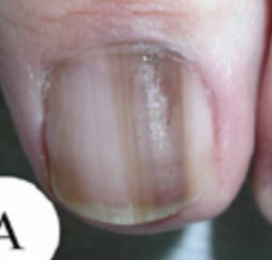 Nail melanoma. Note the Hutchinson's sign at the cuticle or nail fold. There's a second Hutchinson's sign at the top of the nail, in the skin. 