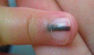 The benign mole extends beyond the cuticle and into the skin of this child's finger. Source: Researchgate.net.