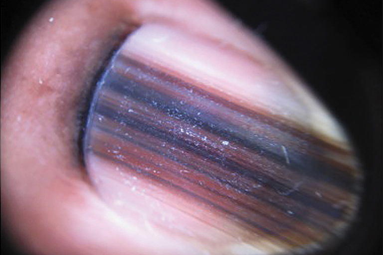 Hutchinson's Sign vs. PseudoHutchinson's Sign » Scary Symptoms