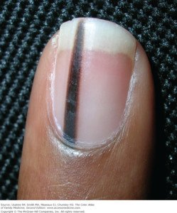 Longitudinal melanychia (elongated pigment in a nail bed). Note what appears to be a Hutchinson's sign at the bottom of the nail (proximal area). The dark appears to be extending into the nail fold, cuticle and even beyond that. However, this band turned out to be a benign mole. Credit: Richard P. Usatine, MD.