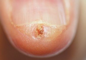 Nail squamous cell carcinoma. Credit: N Engl J Med 2012; 367:2240