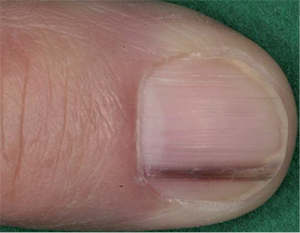 Nail squamous cell carcinoma