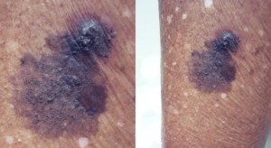 Squamous cell carcinoma on leg