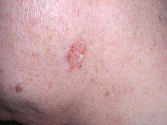 Actinic Keratosis Appearance vs. Squamous Cell Carcinoma
