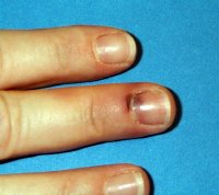 Toenail (Subungual Hematoma) vs. Melanoma: Visible Differences » Scary ...