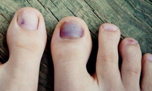 Toenail (Subungual Hematoma) vs. Melanoma: Visible ...