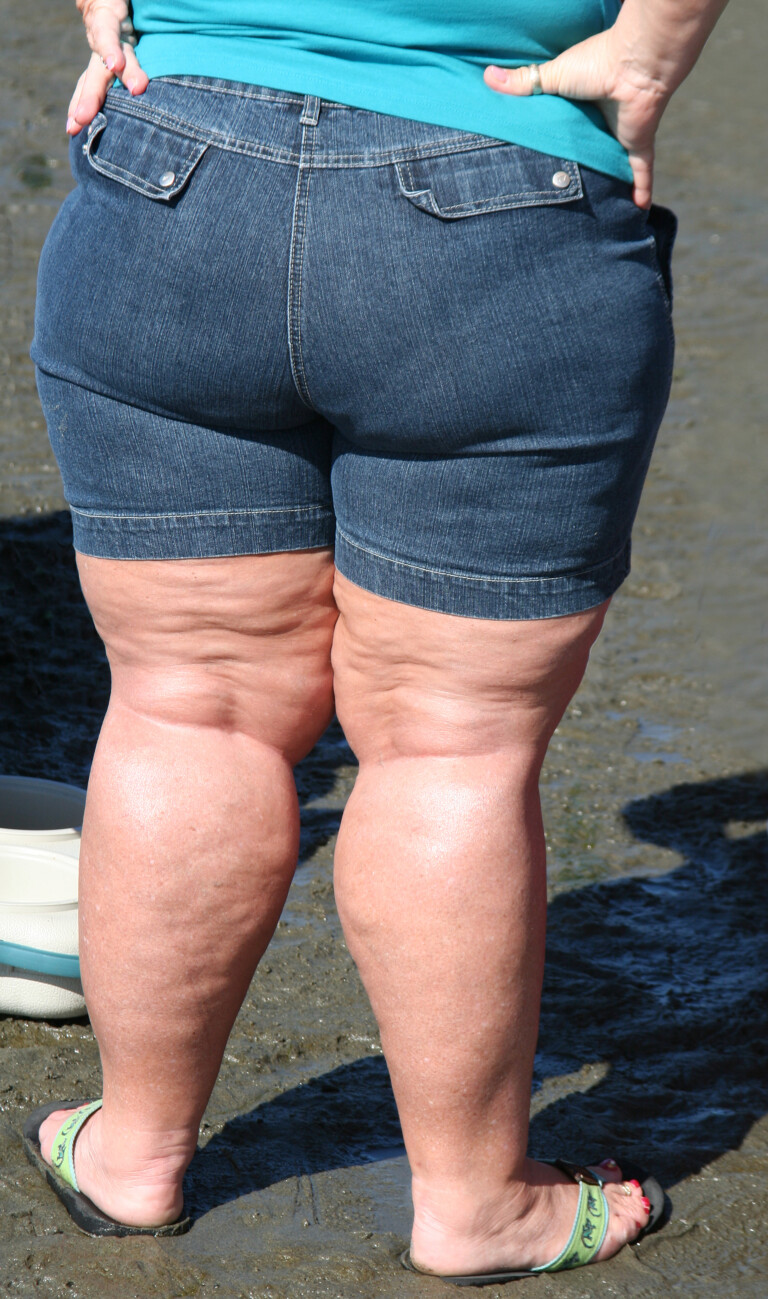 Can Weight Loss Substitute for Knee Replacement Surgery? » Scary Symptoms