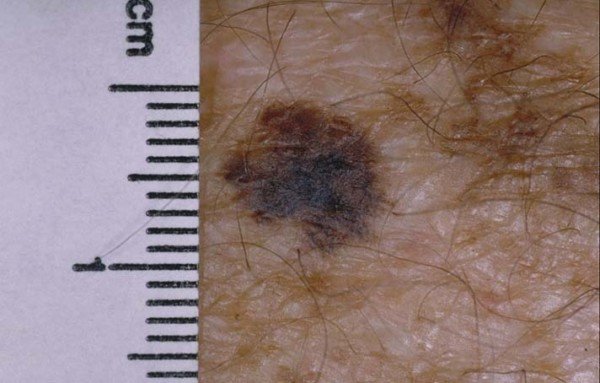 Can a Melanoma Survivor Live 30 Years? » Scary Symptoms