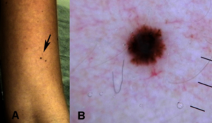 Tiny melanoma, 1.6 mm. Source: Dermatol Pract Concept. 2013 Apr. Copyright ©2013 Pellizzari et al.