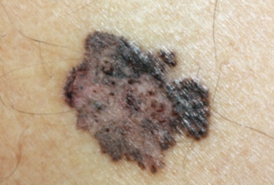 Can a Melanoma Mole Spontaneously Disappear or Regress? » Scary Symptoms