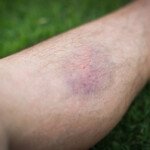 Can a DVT Cause a Bruise Like the Ones We See Often?