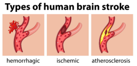 How High Must Blood Pressure Get to Cause Stroke? » Scary Symptoms