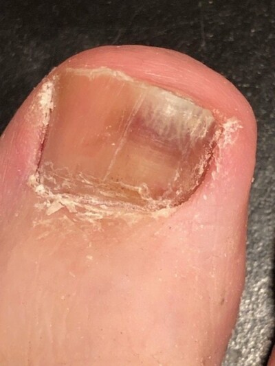 Big Toenail Subungual Hematoma: Images Show Healing Over Time » Scary ...