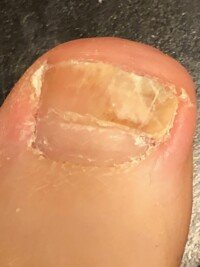 Big Toenail Subungual Hematoma: Images Show Healing Over Time » Scary ...