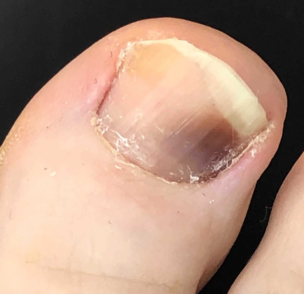 Big Toenail Subungual Hematoma Images Show Healing Over Time Scary 