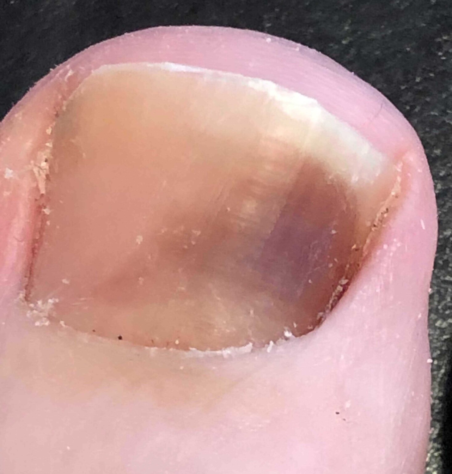 Big Toenail Subungual Hematoma: Images Show Healing Over Time » Scary ...