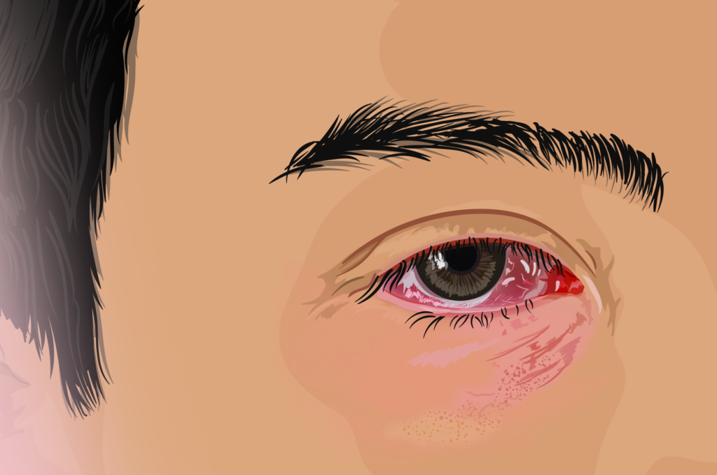 Blood in Eye After Sudden Bad Headache Should You Worry? » Scary Symptoms