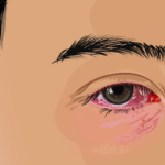 Blood in Eye After Sudden Bad Headache: Should You Worry?