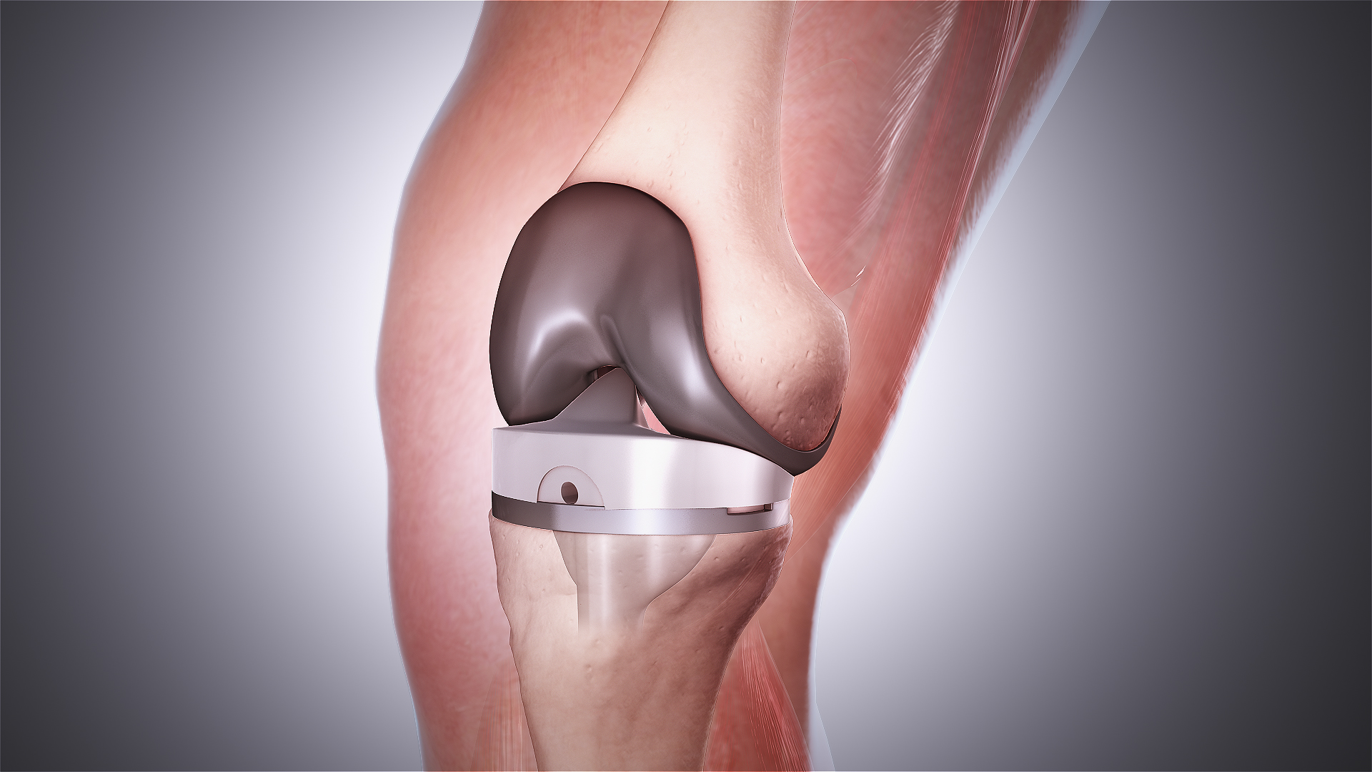 WHY Do Younger Adults Have Total Knee Replacement?
