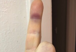 Sudden Purple Bruise On Underside Of Index Finger Scary Symptoms