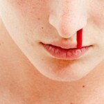 Can a Stroke or TIA Cause a Nosebleed?