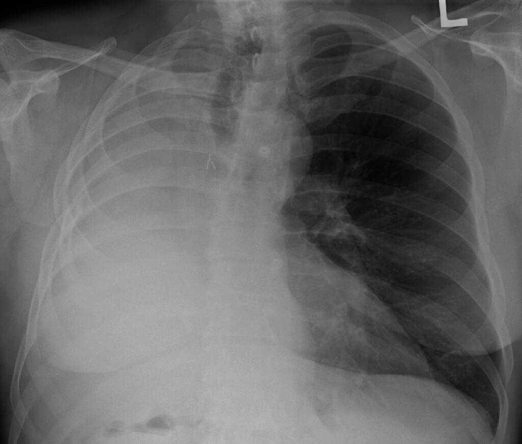 Can a Person Live with just Half of One Lung? » Scary Symptoms