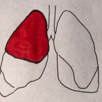 Can a Person Live with just Half of One Lung?