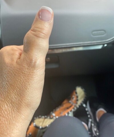Painless Slow Growing Lump Bulge in Thumb: What Is This? » Scary Symptoms