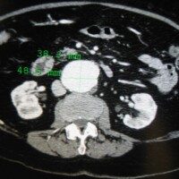 Can Imaging of the Abdomen Miss an Aortic Aneurysm?