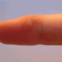 Can a Wart on a Hand or Finger Ever Turn into Melanoma?
