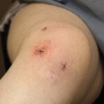 Meniscus Tear + Morbid Obesity: Why a Surgeon Won’t Operate