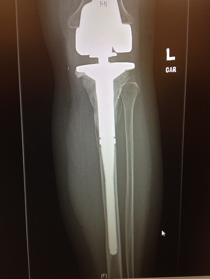 Runner’s Lower Leg Pain Below Knee Was a Missed Cancer » Scary Symptoms