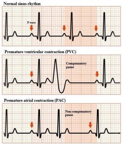 Can PVC's Harm Athletic Teens With Normal Hearts? » Scary Symptoms