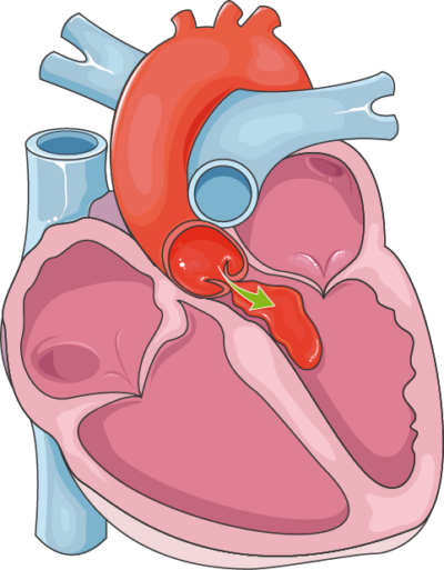 Can Heart Problems Cause Pulsatile Tinnitus