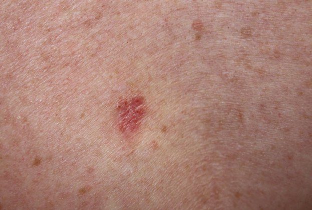 How Many Basal Cell Carcinomas Can You Get at Once? » Scary Symptoms