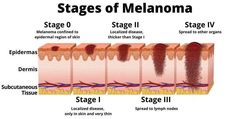 how-can-a-tiny-melanoma-already-be-terminal-cancer-scary-symptoms